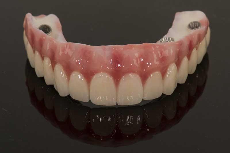 SmileDent Dental Studio | Aesthetic E-Max Solutions, Prettau Bridge and Implant Solutions