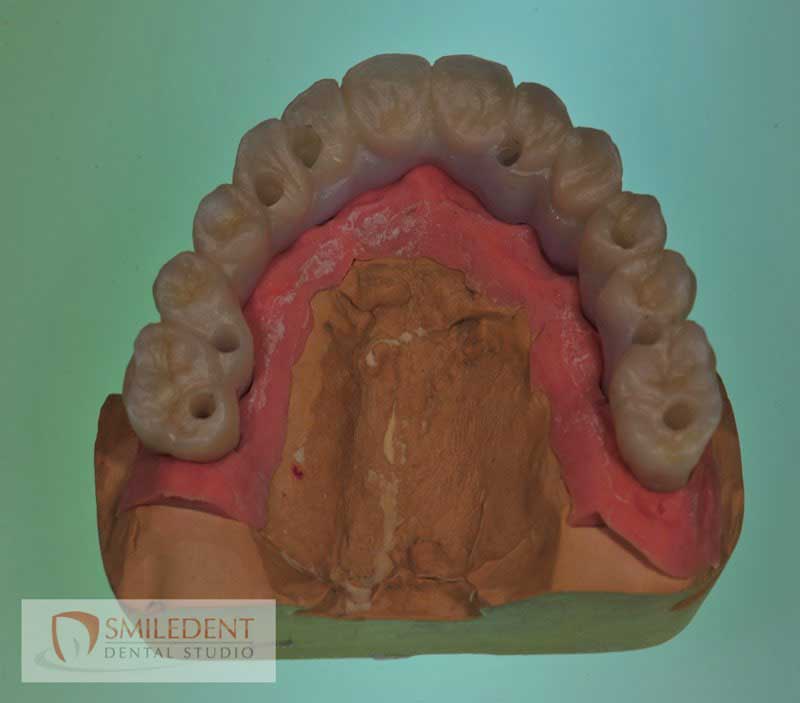 SmileDent Dental Studio | PFM AND FCM Solutions, Aesthetic E-Max Solutions and Implant Solutions