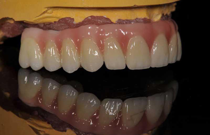 SmileDent Dental Studio | Acrylic Hybrid Solutions, CHROME™ GuidedSMILE™ and Surgical Guides