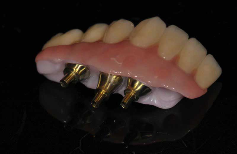 SmileDent Dental Studio | PFM AND FCM Solutions, Aesthetic E-Max Solutions and CHROME trade  GuidedSMILE trade 