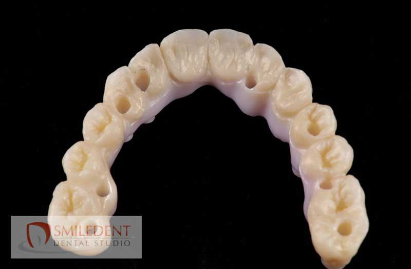 SmileDent Dental Studio | Prettau Bridge, Acrylic Hybrid Solutions and Implant Solutions