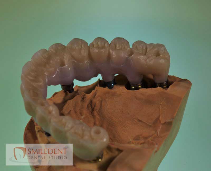 SmileDent Dental Studio | Zirconia, PFM AND FCM Solutions and Surgical Guides