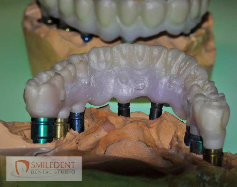 SmileDent Dental Studio | Aesthetic E-Max Solutions, PFM AND FCM Solutions and Acrylic Hybrid Solutions