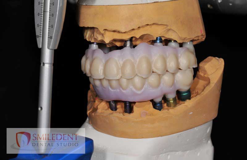 SmileDent Dental Studio | Implant Solutions, Aesthetic E-Max Solutions and Zirconia
