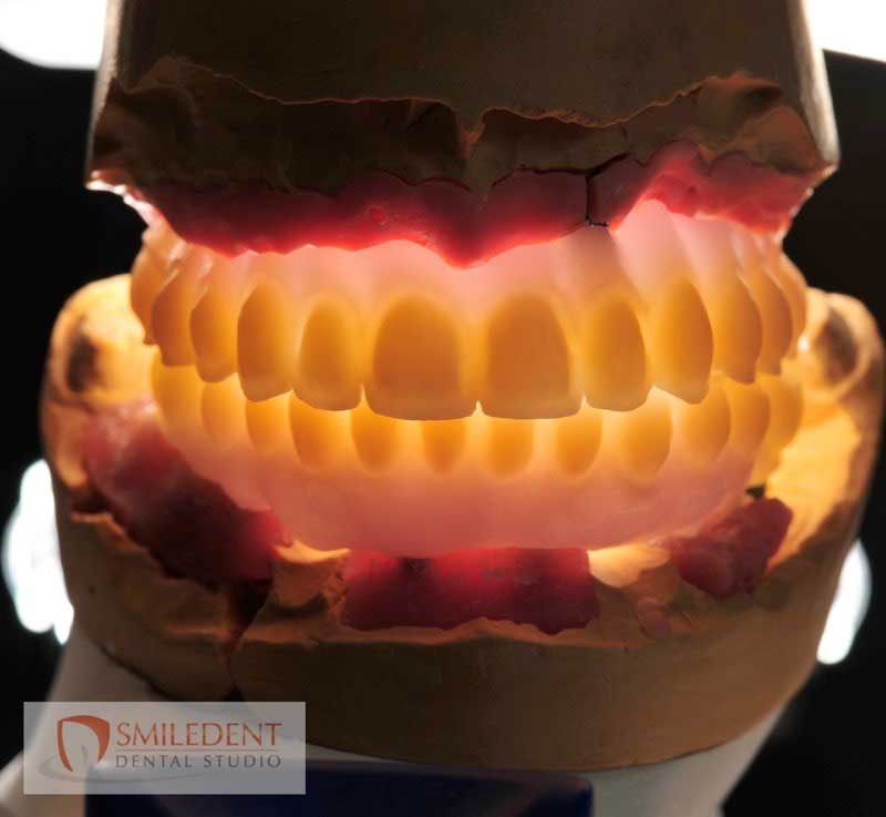 SmileDent Dental Studio | Zirconia, CHROME™ GuidedSMILE™ and PFM AND FCM Solutions