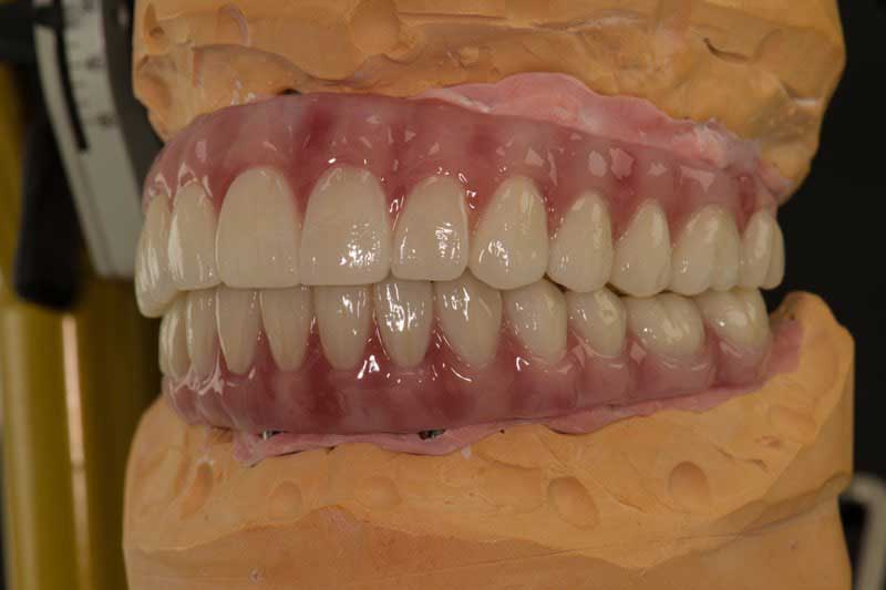 SmileDent Dental Studio | Zirconia, nSequence® Protocol  and CHROME™ GuidedSMILE™