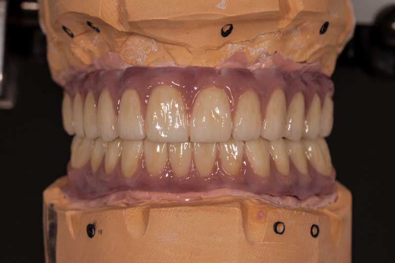 SmileDent Dental Studio | Acrylic Hybrid Solutions, Aesthetic E-Max Solutions and Surgical Guides