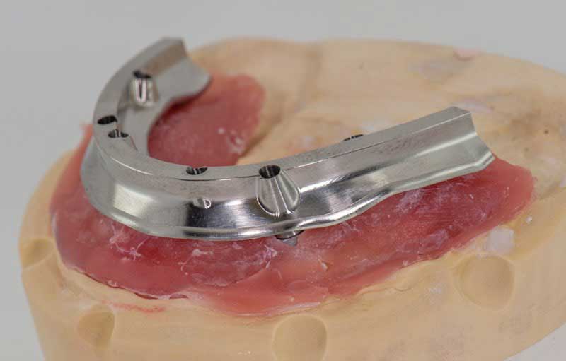 SmileDent Dental Studio | Aesthetic E-Max Solutions, CHROME™ GuidedSMILE™ and PFM AND FCM Solutions