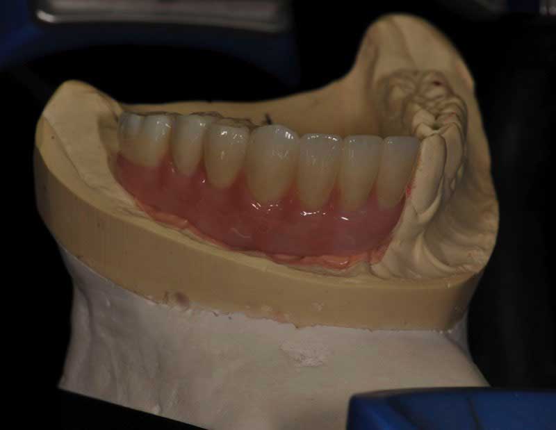 SmileDent Dental Studio | Implant Solutions, CHROME™ GuidedSMILE™ and PFM AND FCM Solutions