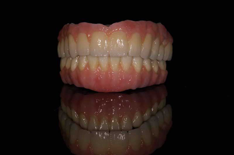 SmileDent Dental Studio | CHROME trade  GuidedSMILE trade , Acrylic Hybrid Solutions and nSequence reg  Protocol 