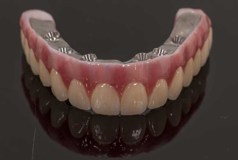 SmileDent Dental Studio | Surgical Guides, Zirconia and Prettau Bridge