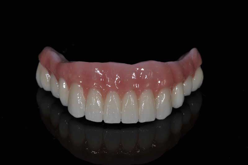 SmileDent Dental Studio | nSequence reg  Protocol , PFM AND FCM Solutions and Prettau Bridge