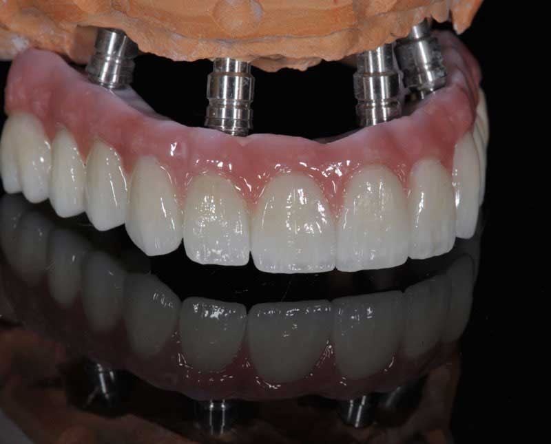 SmileDent Dental Studio | Acrylic Hybrid Solutions, Aesthetic E-Max Solutions and Implant Solutions