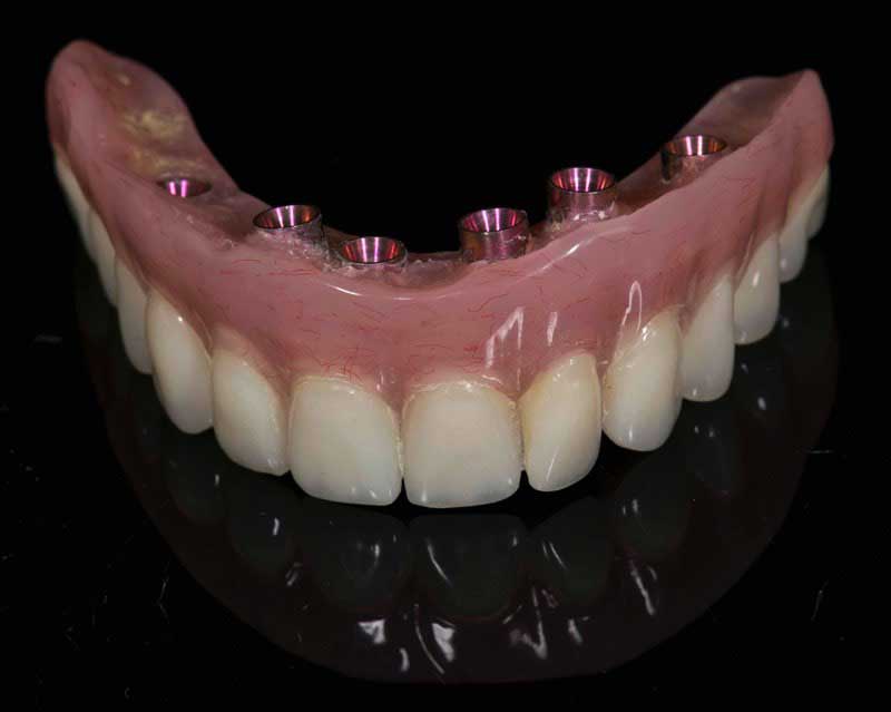 SmileDent Dental Studio | Zirconia, Aesthetic E-Max Solutions and Implant Solutions