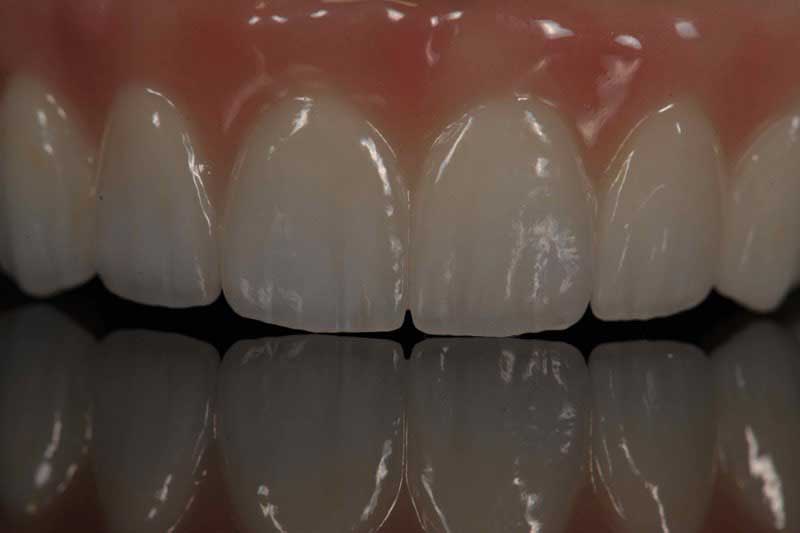 SmileDent Dental Studio | Implant Solutions, Surgical Guides and Aesthetic E-Max Solutions