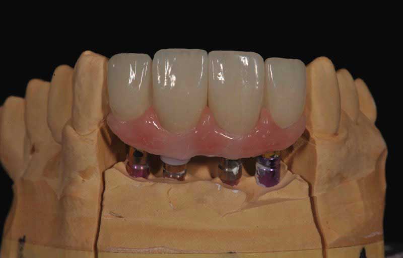 SmileDent Dental Studio | Implant Solutions, CHROME trade  GuidedSMILE trade  and Aesthetic E-Max Solutions