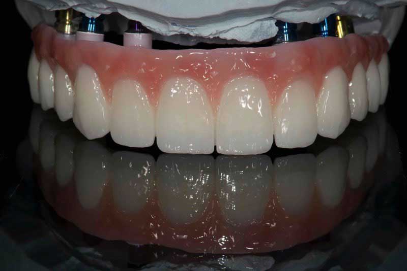 SmileDent Dental Studio | PFM AND FCM Solutions, Surgical Guides and Prettau Bridge