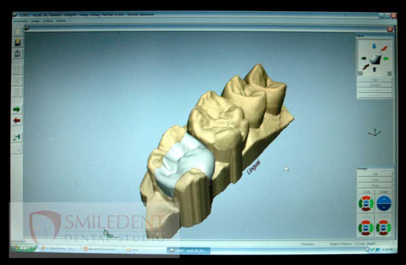 SmileDent Dental Studio | PFM AND FCM Solutions, Aesthetic E-Max Solutions and Surgical Guides