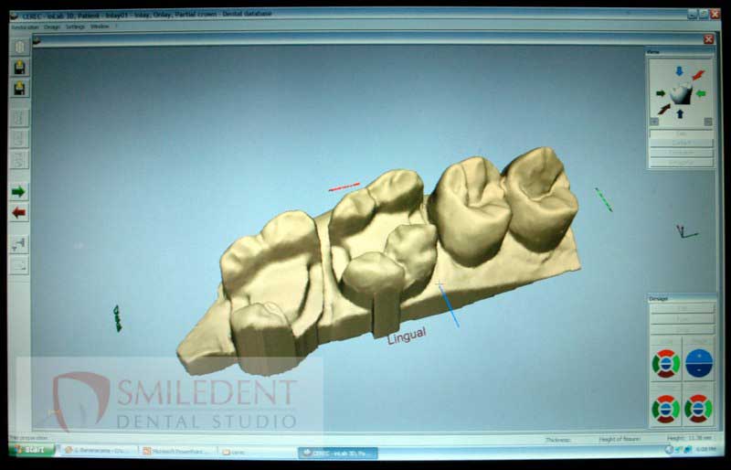 SmileDent Dental Studio | Prettau Bridge, Aesthetic E-Max Solutions and PFM AND FCM Solutions