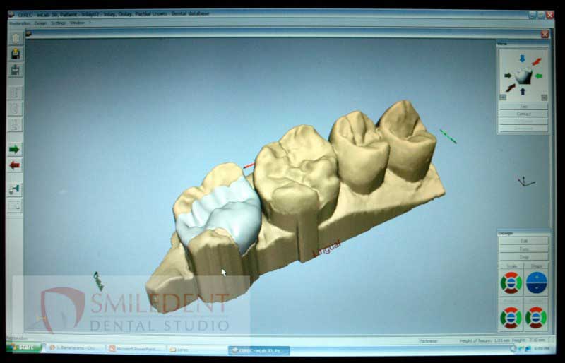 SmileDent Dental Studio | Acrylic Hybrid Solutions, CHROME trade  GuidedSMILE trade  and nSequence reg  Protocol 