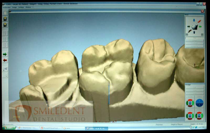 SmileDent Dental Studio | Prettau Bridge, CHROME trade  GuidedSMILE trade  and Implant Solutions