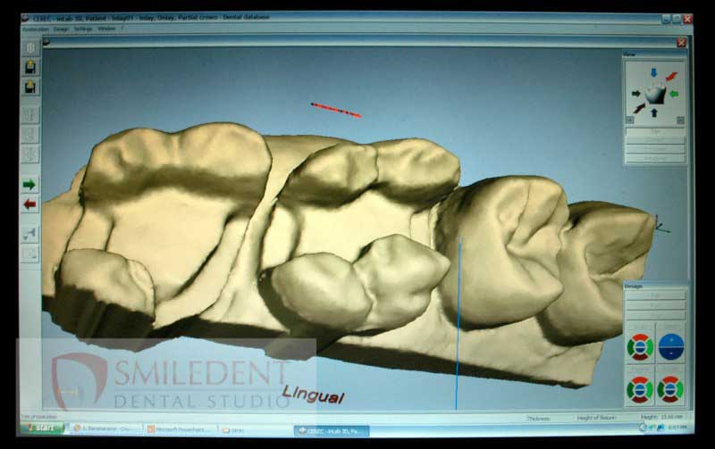 SmileDent Dental Studio | nSequence reg  Protocol , Implant Solutions and Surgical Guides