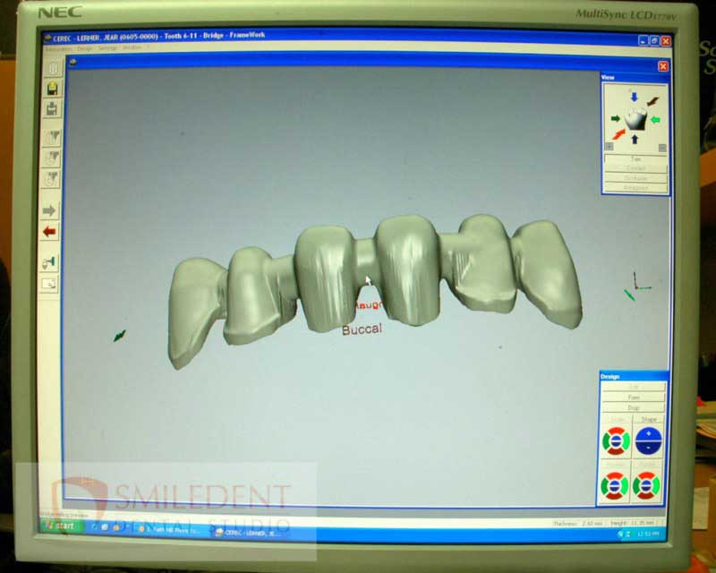 SmileDent Dental Studio | Surgical Guides, Prettau Bridge and Implant Solutions