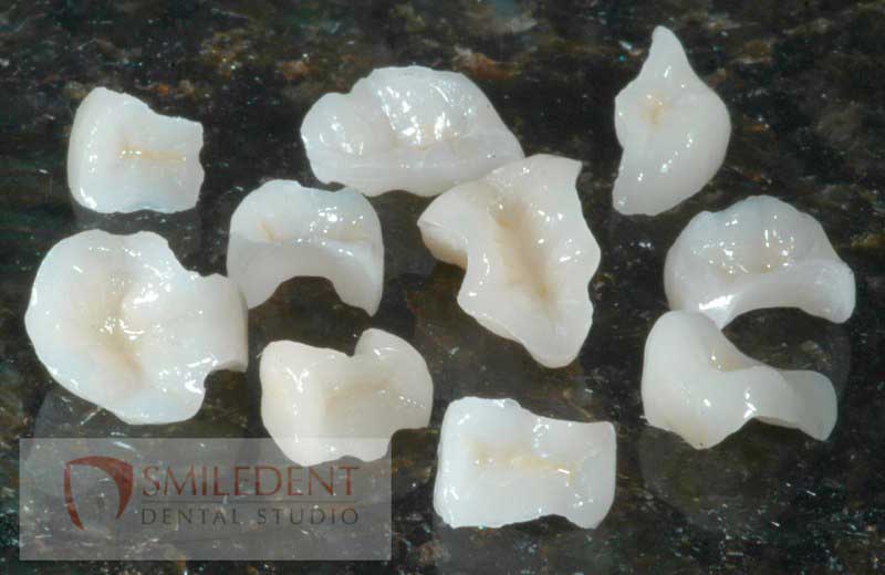 SmileDent Dental Studio | PFM AND FCM Solutions, Aesthetic E-Max Solutions and CHROME trade  GuidedSMILE trade 