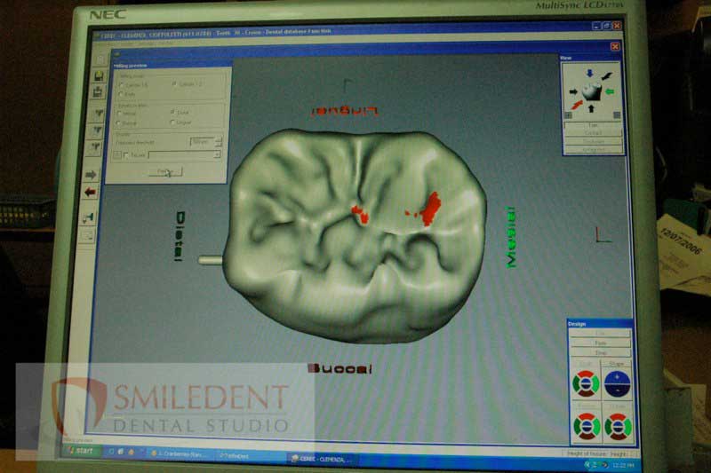 SmileDent Dental Studio | Prettau Bridge, Acrylic Hybrid Solutions and Implant Solutions