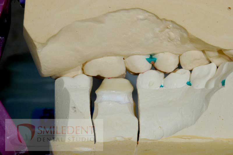SmileDent Dental Studio | Zirconia, PFM AND FCM Solutions and Surgical Guides