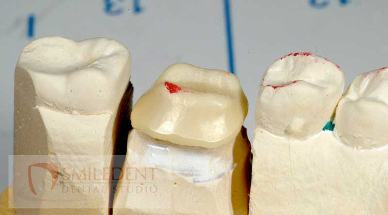 SmileDent Dental Studio | Aesthetic E-Max Solutions, PFM AND FCM Solutions and Acrylic Hybrid Solutions