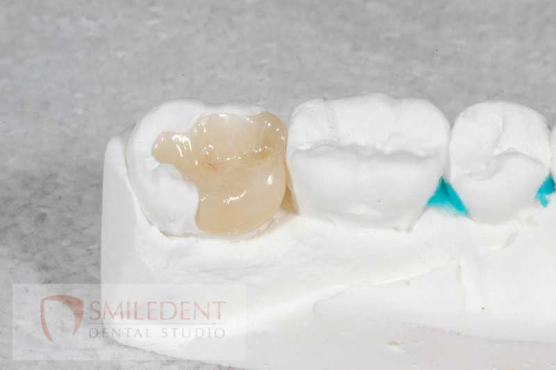 SmileDent Dental Studio | CHROME trade  GuidedSMILE trade , Acrylic Hybrid Solutions and nSequence reg  Protocol 