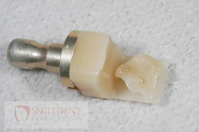 SmileDent Dental Studio | nSequence reg  Protocol , PFM AND FCM Solutions and Prettau Bridge