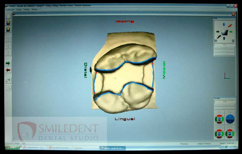 SmileDent Dental Studio | Acrylic Hybrid Solutions, Aesthetic E-Max Solutions and Implant Solutions
