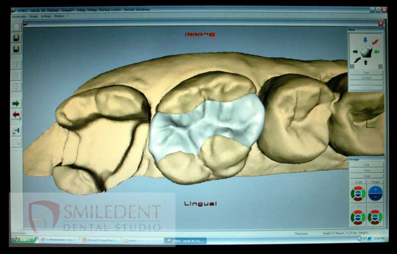 SmileDent Dental Studio | Implant Solutions, Surgical Guides and Aesthetic E-Max Solutions