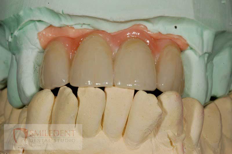 SmileDent Dental Studio | PFM AND FCM Solutions, Aesthetic E-Max Solutions and Surgical Guides