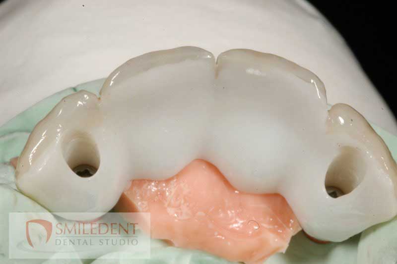 SmileDent Dental Studio | Prettau Bridge, Aesthetic E-Max Solutions and PFM AND FCM Solutions