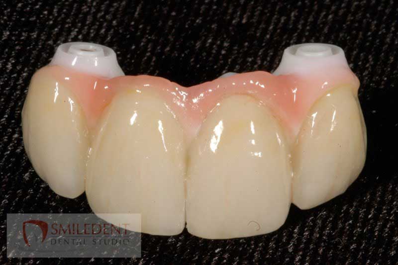 SmileDent Dental Studio | Acrylic Hybrid Solutions, CHROME trade  GuidedSMILE trade  and nSequence reg  Protocol 