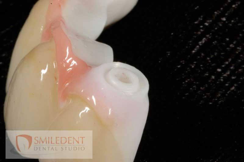 SmileDent Dental Studio | Prettau Bridge, CHROME trade  GuidedSMILE trade  and Implant Solutions