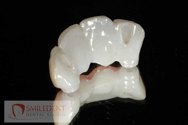 SmileDent Dental Studio | nSequence reg  Protocol , Implant Solutions and Surgical Guides