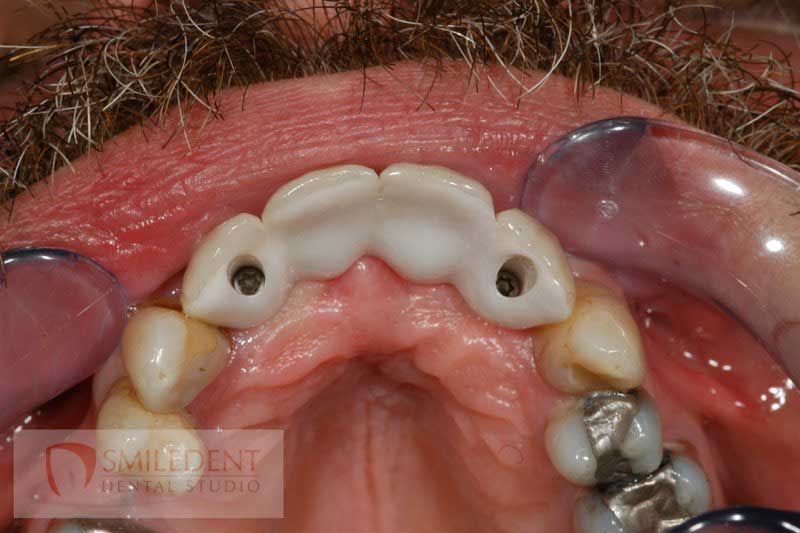 SmileDent Dental Studio | Surgical Guides, Prettau Bridge and Implant Solutions