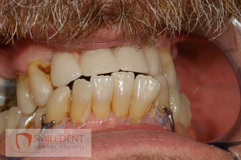 SmileDent Dental Studio | Surgical Guides, nSequence reg  Protocol  and Aesthetic E-Max Solutions