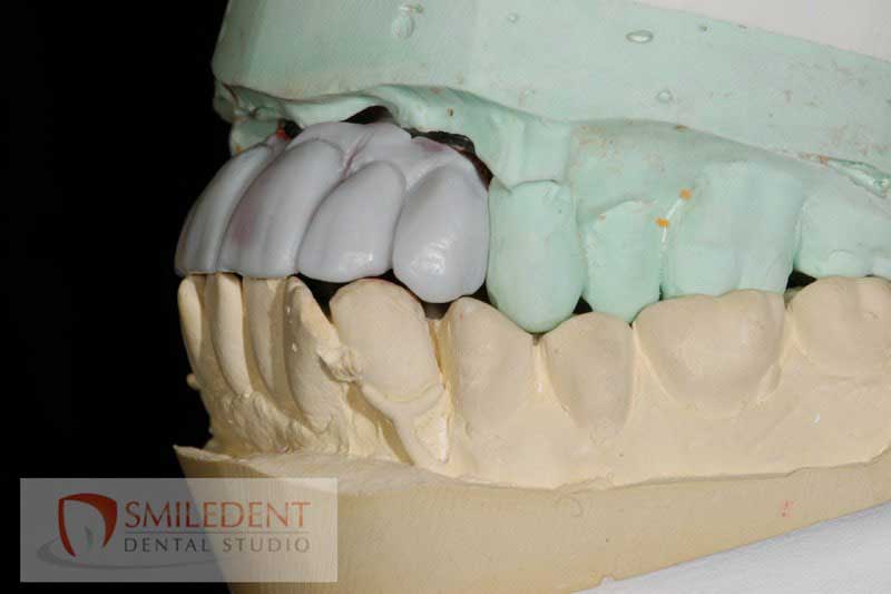 SmileDent Dental Studio | CHROME trade  GuidedSMILE trade , Acrylic Hybrid Solutions and nSequence reg  Protocol 