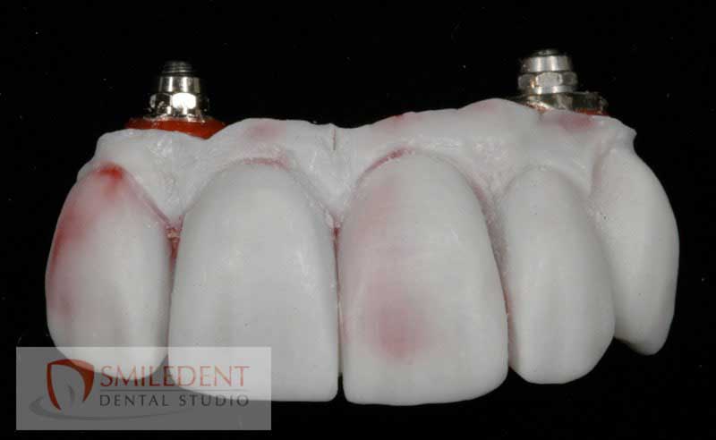 SmileDent Dental Studio | nSequence reg  Protocol , PFM AND FCM Solutions and Prettau Bridge