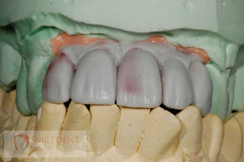 SmileDent Dental Studio | Acrylic Hybrid Solutions, Aesthetic E-Max Solutions and Implant Solutions