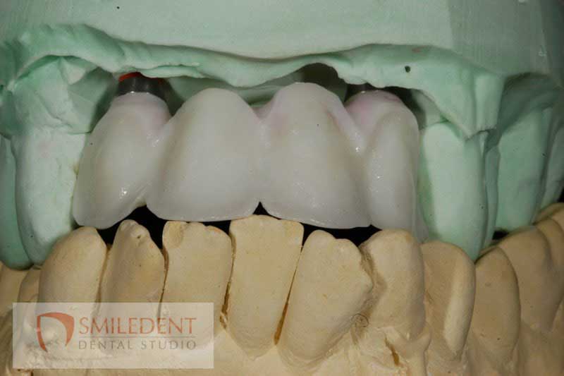 SmileDent Dental Studio | Zirconia, Aesthetic E-Max Solutions and Implant Solutions