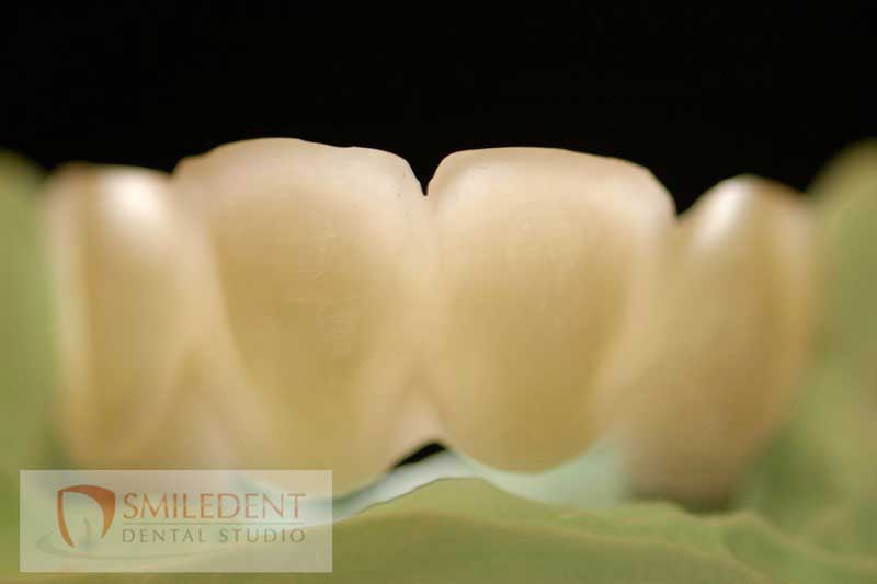 SmileDent Dental Studio | Implant Solutions, Surgical Guides and Aesthetic E-Max Solutions