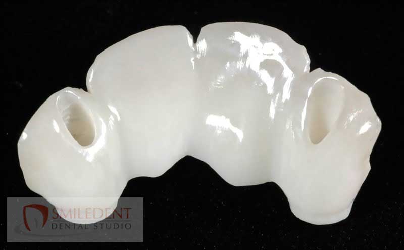 SmileDent Dental Studio | Implant Solutions, CHROME trade  GuidedSMILE trade  and Aesthetic E-Max Solutions