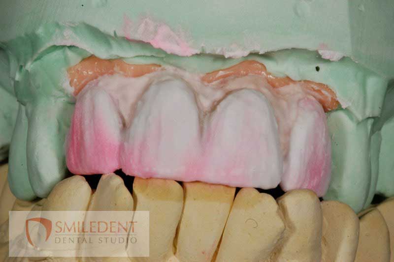 SmileDent Dental Studio | PFM AND FCM Solutions, Surgical Guides and Prettau Bridge