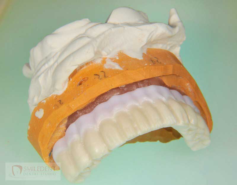 SmileDent Dental Studio | PFM AND FCM Solutions, Aesthetic E-Max Solutions and Surgical Guides